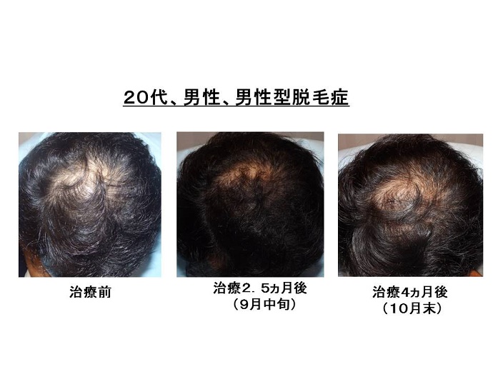 男性型脱毛症　名医""